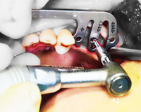 Zestaw prowadnic implantów dentystycznych pozycjoner do sadzenia ustnego przewodnik pozycjonowania wiercenie pozycjonowanie linijka linijka kątowa Implant narzędzia dentysta 4